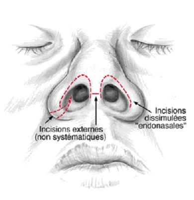 nez cicatrice