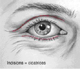 oeil cicatrice