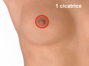 CHIRURGIE DE L’HYPERTROPHIE MAMMAIRE - 1 cicatrice