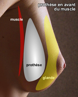 PROTHESES MAMMAIRES cicatrices