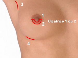 PROTHESES MAMMAIRES cicatrices