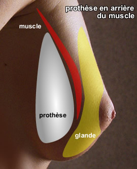 PROTHESES MAMMAIRES cicatrices