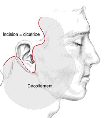 visage cicatrice